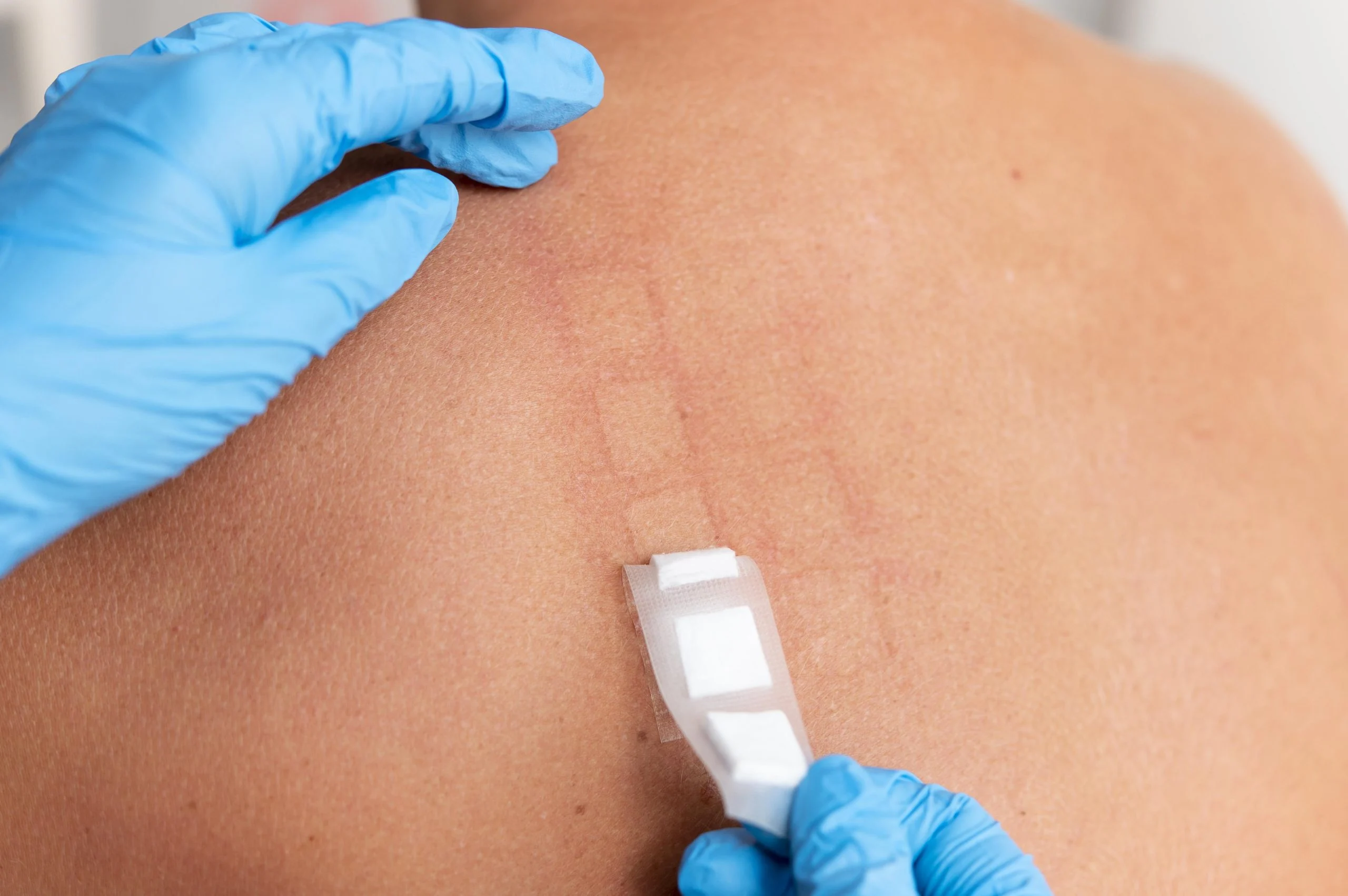 skin-allergy-reaction-person-s-back-scaled skin-allergy-reaction-person-s-back-scaled
